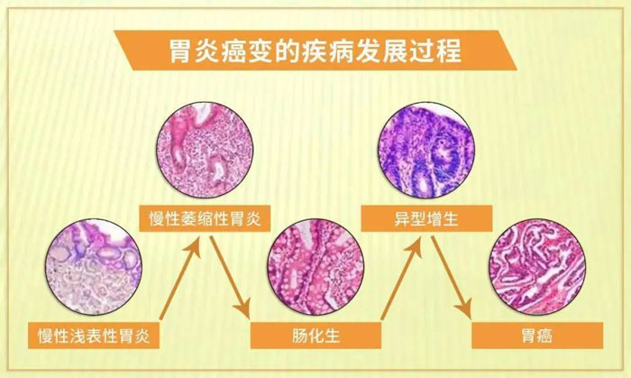 正常胃黏膜-浅表性胃炎-萎缩性胃炎-肠化生-异型增生-肠型胃癌