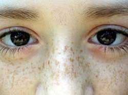 治疗雀斑大概多少钱,调Q激光治疗雀斑这种黑色素类疾病的效果是非常好的,它不会损伤正常皮肤组织,只对病发部位产生作用,治疗雀斑采用调Q激光联合药物综合治疗雀斑是最好的选择。