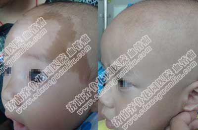 激光祛咖啡斑会不会当时有效果之后又复发,咖啡斑大多数是先天性的,可生长在孩子身体任何部位,调Q激光是目前治疗咖啡斑最好的医疗设备,不但不会损伤正常皮肤组织,还能促进胶原蛋白再生和重塑,治疗咖啡斑的过程没有痛苦。