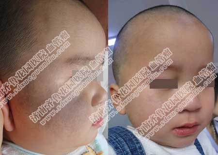 滨州邹平县治疗太田痣好的医院是哪家,建议选择济南齐鲁花园医院,调Q激光治疗仪是治疗黑胎记太田痣最好的仪器设备,联合我们自主研发的修复剂综合治疗,能恢复健康平滑肌肤状态。