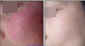 枣庄峄城区去除红血丝好的医院是哪个,美国赛诺秀双波长染料激光工作站能量充足,去除红血丝的过程无痛苦,患者不受罪,去除红血丝最好选择正规专业的医院。