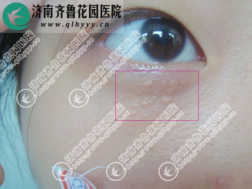 图一:眼皮下的汗管瘤在济南齐鲁花园医院皮肤科用激光治疗前