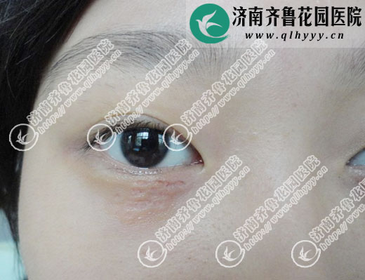 图二:眼皮下的汗管瘤在济南齐鲁花园医院皮肤科用激光治疗时的即刻反应