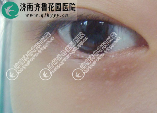 图三:眼皮下的汗管瘤在济南齐鲁花园医院皮肤科用激光治疗一次后的恢复情况