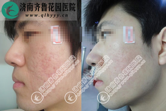 ðî´¯°¼¿Ó»¼ÕßÓõãÕ󼤹âÖÎÁÆÇ°ºó¶Ô±Èͼ