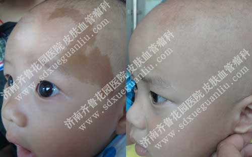 常见的新生儿胎记有哪些,新生儿胎记一般可分为色素型和血管型,新生儿胎记的类型比较多,容易被家长以及非专业医生混淆,新生儿胎记只要用对方法是能够彻底治好的。