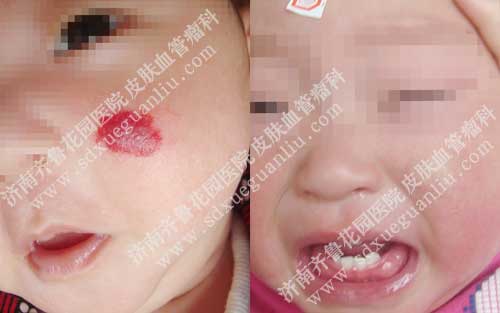 孩子脸上有胎记需要治疗吗血管性胎记有毁容风险