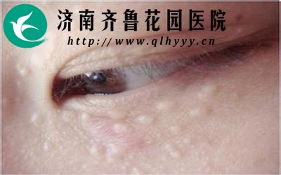 汗管瘤一般生长在眼睑面颈等部位,好发于女性,当人体疲劳或者抵抗地下降时汗管瘤就会越长越多。