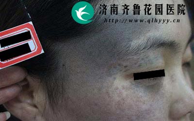 治疗太田痣一定要选择专业的医院来治疗,否则治疗不当容易留下疤痕甚至毁容。