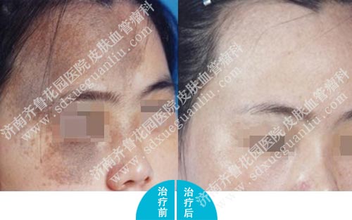 激光治疗太田痣需要注意什么