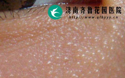 汗管瘤发病时皮肤上会出现呈皮肤色的丘疹。