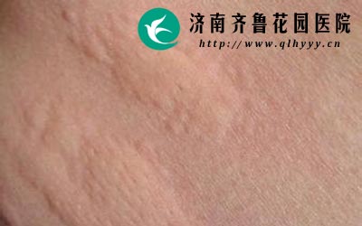 荨麻疹是皮肤过敏所导致的有一定的遗传因素。