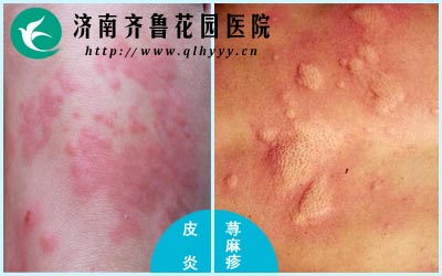 皮炎的瘙痒程度要比荨麻疹严重。