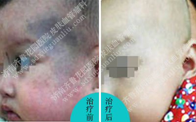 我院皮肤科接诊的一位脸上长有青黑色胎记的小患者,后经诊断为太田痣,那么,治疗太田痣的方法及治疗太田痣的医院哪家好呢。