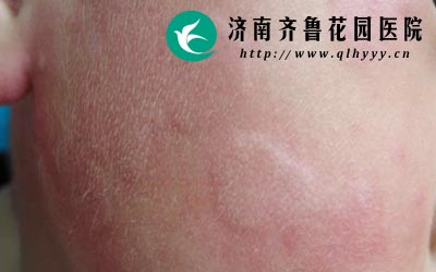 身体的其他疾病也会引发荨麻疹比如扁桃体炎阑尾炎等。