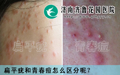 在青少年阶段青春痘就是很常见的,但是脸上长痘痘也并不一定是青春痘,也有可能是扁平疣,那么,扁平疣和青春痘怎么区分呢。