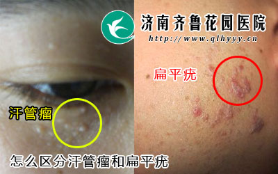 怎么区分汗管瘤和扁平疣,汗管瘤发病好生长在眼睑周围,扁平疣好发病部位在脸部和额头,那么汗管瘤只长在眼周吗。