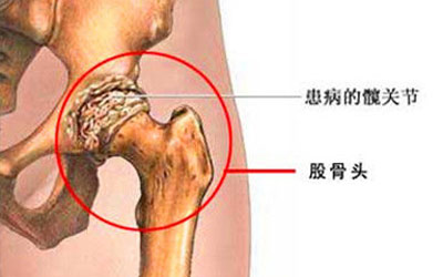 股骨头坏死的症状都有哪些_济南齐鲁花园医院