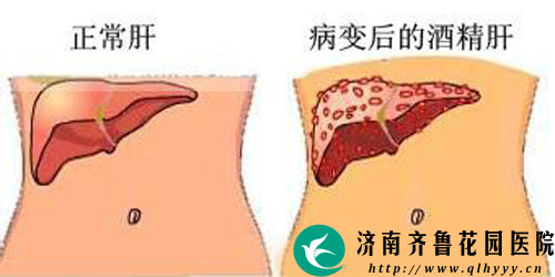 在生活中应该如何预防酒精肝_济南齐鲁花园医院