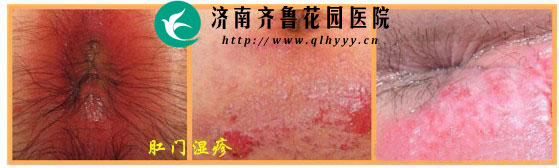 肛门瘙痒的情况下 如何判断是不是肛门湿疹 可以在哪些方面进行判断