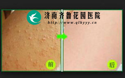 鸡皮肤是怎么形成的 能治好吗_济南齐鲁花园医