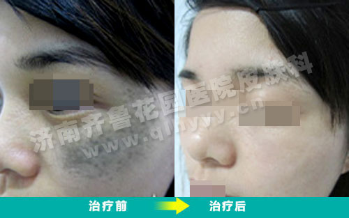 患者脸上的太田痣经我院治疗前后的对比照片