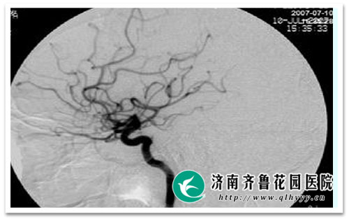 什么情况下需作脑血管造影检查_济南齐鲁花园