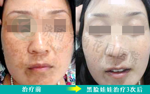 黄褐斑患者在我院治疗前和治疗后的对比照片