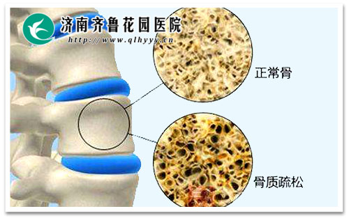 容易导致骨质疏松的三类药_济南齐鲁花园医院