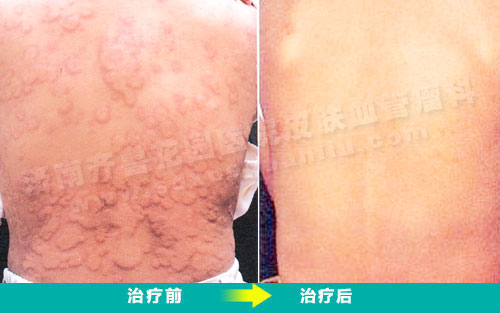 后背荨麻疹治疗前和治疗后的对比照片