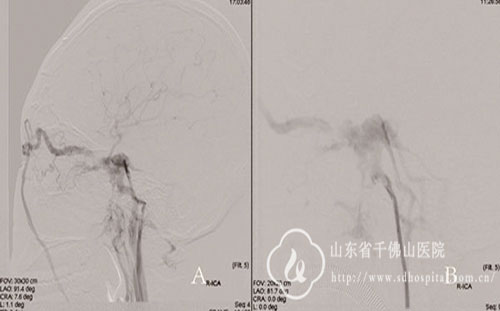 ɽʡǧɽҽԺ֢Ӱ֤ʵΪҲྱڶѹҲྱ