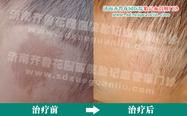 咖啡斑患者经多联阶梯疗法治疗前后对比照片