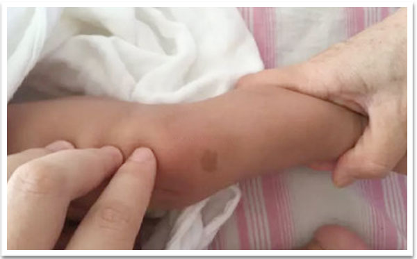 患儿膝盖上长有一块黄豆大小的褐色斑块