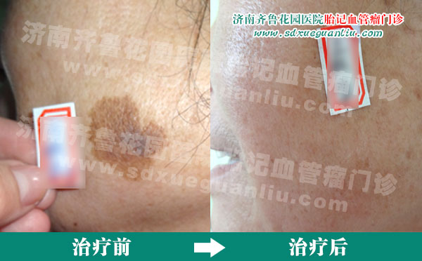 脸上的老年斑治疗后前后对比照片