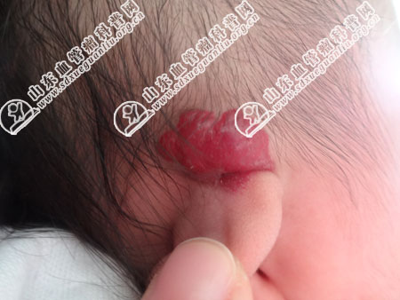 草莓状血管瘤是不是皮下血管瘤比较浅的一种