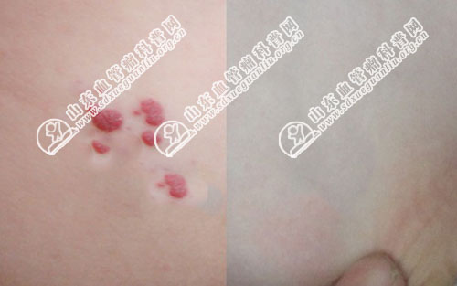 婴儿草莓状血管瘤需要观察多久才能消退