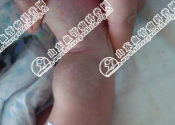 海绵形血管瘤如何诊断