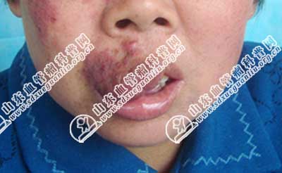 老人身上长了海绵状血管瘤,据说是小时候就有,但是现在嘴唇变形了