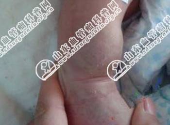 海绵状血管瘤是发生在患者皮下组织的,长在腿上的海绵状血管瘤不及时