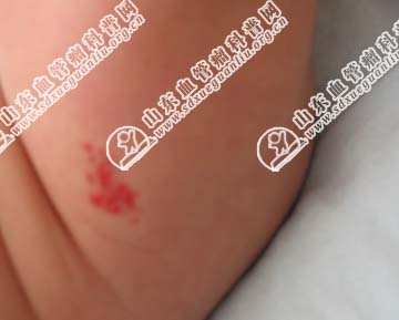 孩子大腿根上长了一个草莓状血管瘤该怎么治