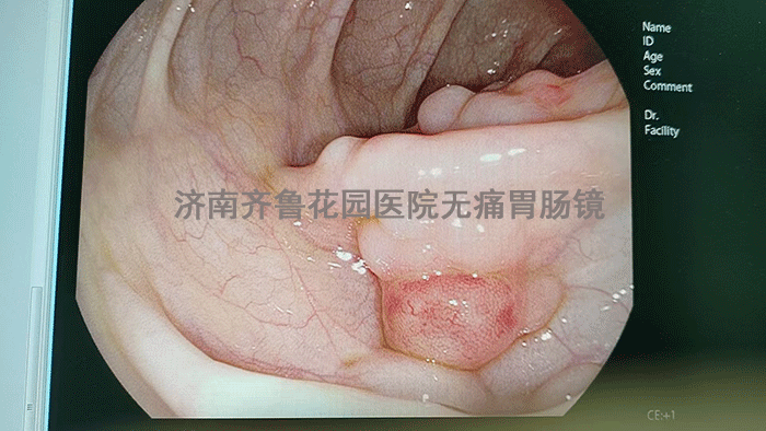 腺瘤性息肉病