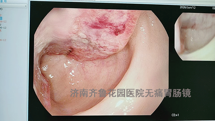 诊断:直肠占位