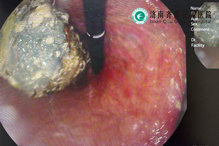 警防无中生有胃中生石