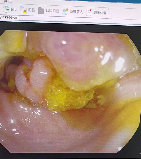 胃镜室肠镜检查发现一例结肠占位患者