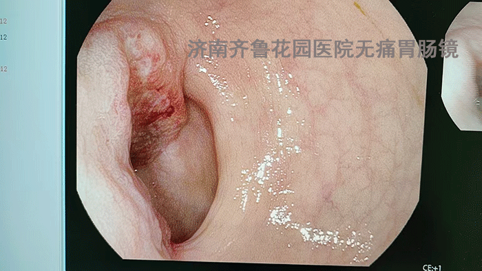 诊断:直肠占位