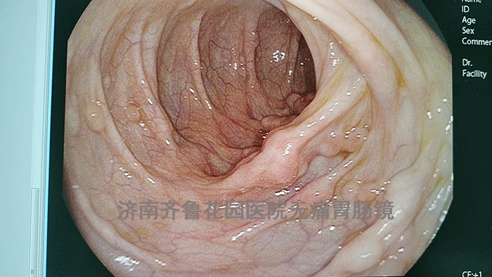 腺瘤性息肉病