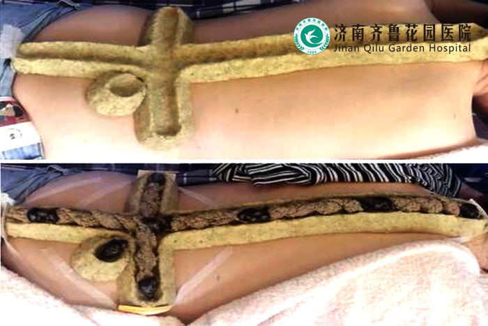 夏至哪些症状适合做督灸