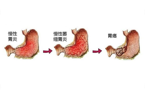 胃病如果不及时处理,可能会引起胃萎缩,肠上皮化生等疾病,最终导致胃癌。