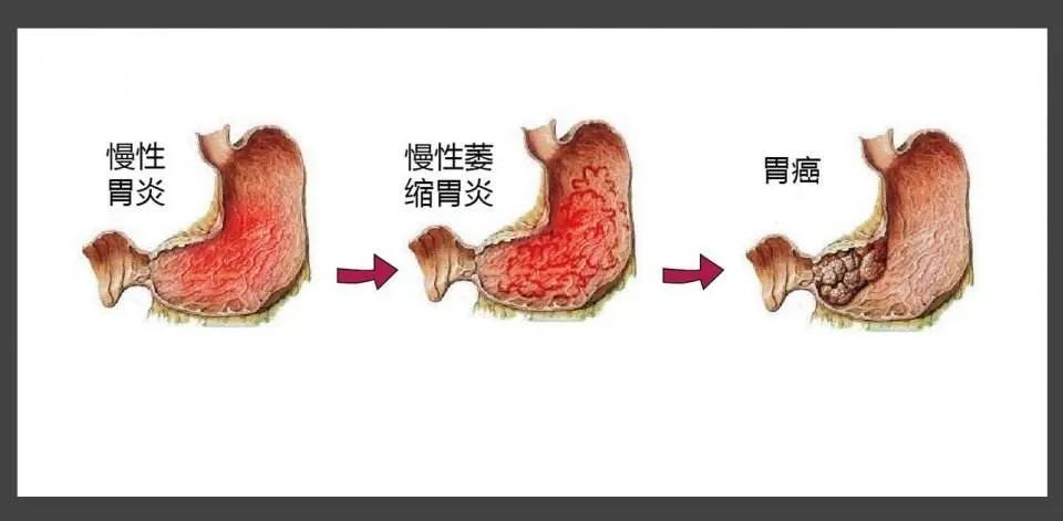 幽门螺旋杆菌与胃癌之间的联系是非常的紧密的