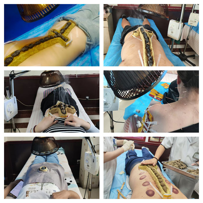 上班久坐导致的关节、颈椎病、肩周炎等，针灸、拔罐、督灸等多种治疗手段可选